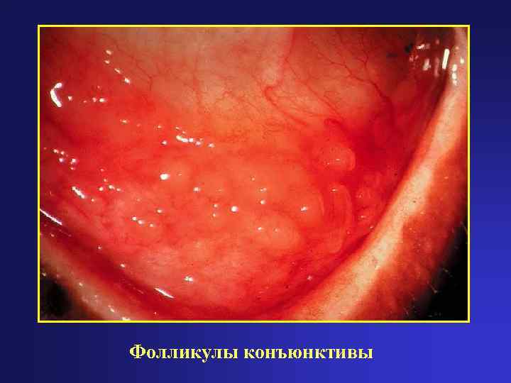 Фолликулы конъюнктивы 