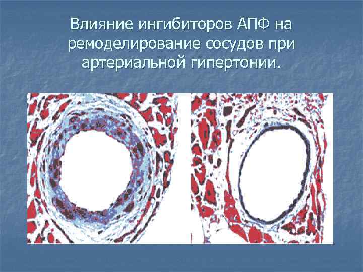 Влияние ингибиторов АПФ на ремоделирование сосудов при  артериальной гипертонии. 