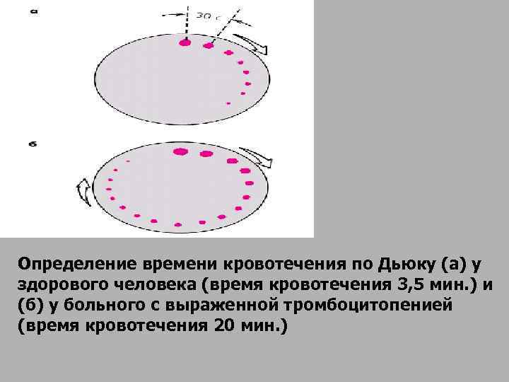 Определение времени кровотечения по Дьюку (а) у здорового человека (время кровотечения 3, 5 мин.