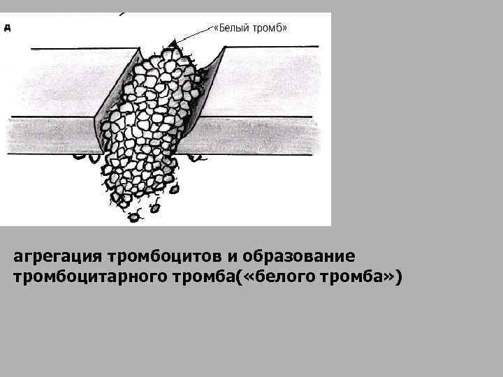 агрегация тромбоцитов и образование тромбоцитарного тромба( «белого тромба» )  