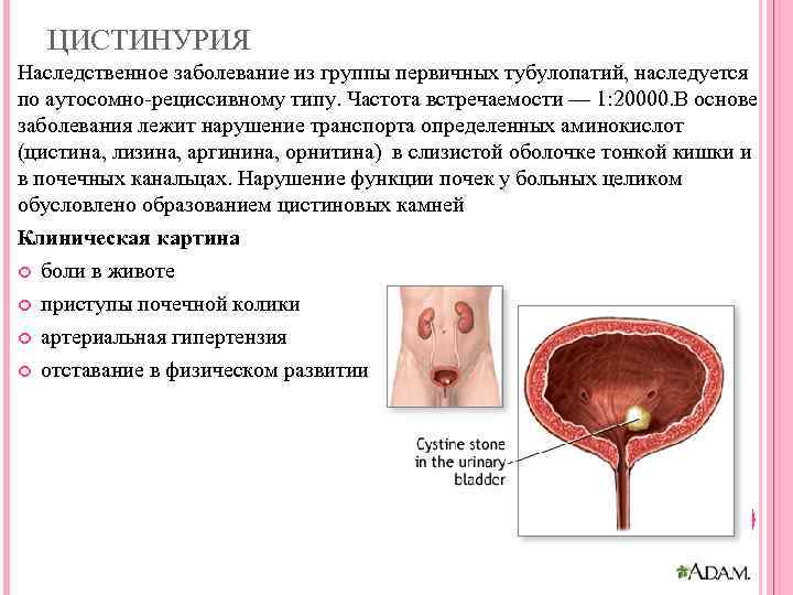   ЦИСТИНУРИЯ Наследственное заболевание из группы первичных тубулопатий, наследуется по аутосомно-рециссивному типу. Частота