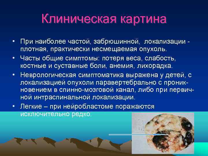   Клиническая картина • При наиболее частой, забрюшинной,  локализации плотная, практически несмещаемая