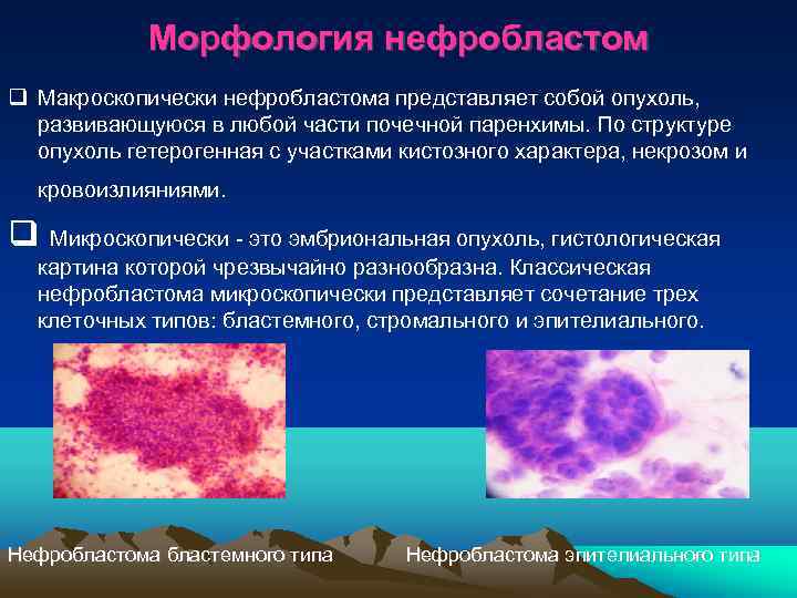   Морфология нефробластом  Макроскопически нефробластома представляет собой опухоль, развивающуюся в любой части