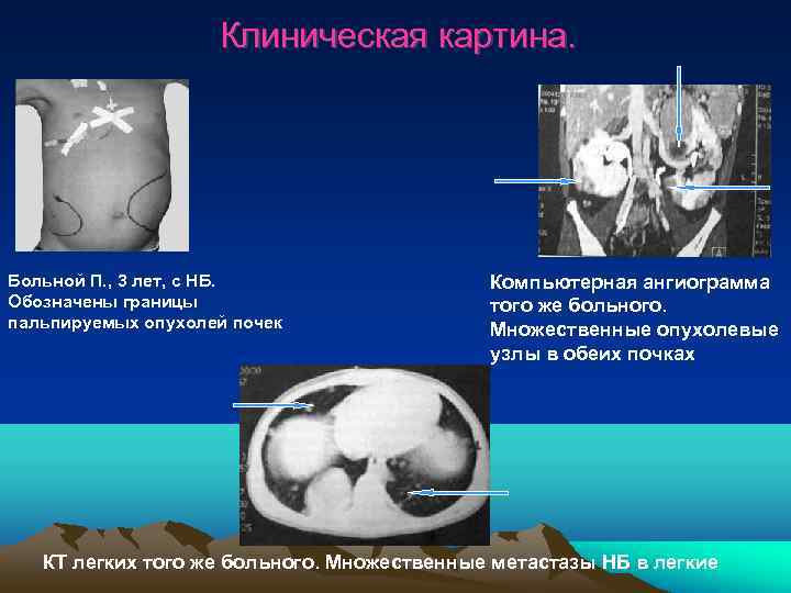     Клиническая картина. Больной П. , 3 лет, с НБ. 