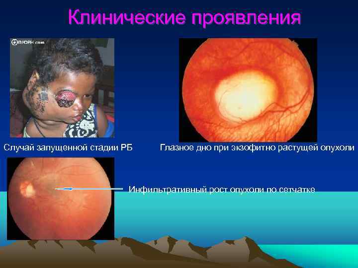    Клинические проявления Случай запущенной стадии РБ Глазное дно при экзофитно растущей