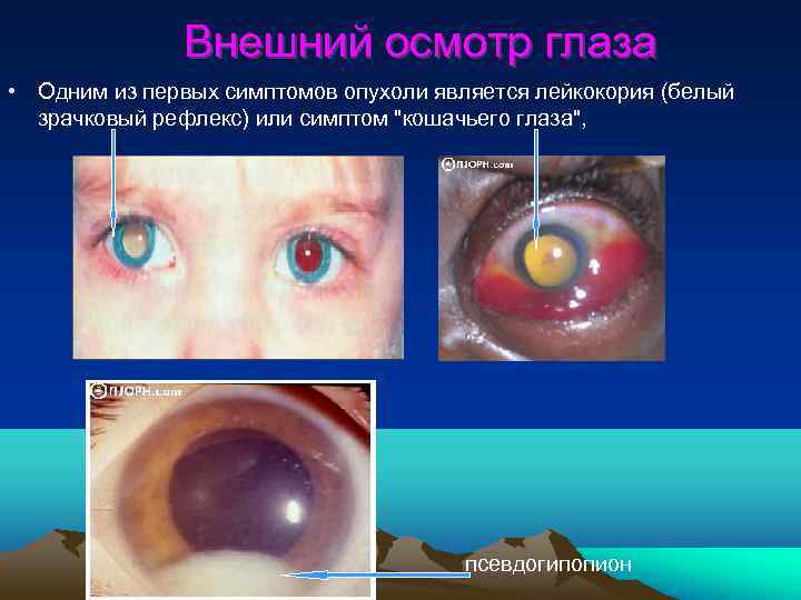     Внешний осмотр глаза • Одним из первых симптомов опухоли является