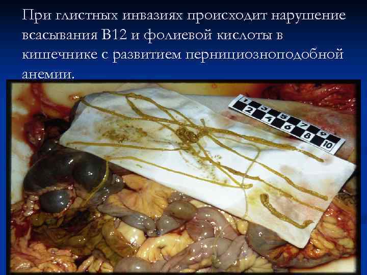 При глистных инвазиях происходит нарушение всасывания В 12 и фолиевой кислоты в кишечнике с
