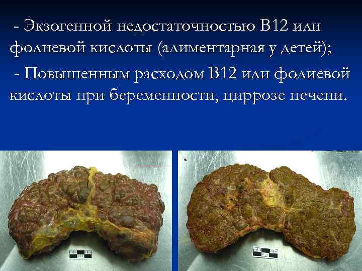  - Экзогенной недостаточностью В 12 или фолиевой кислоты (алиментарная у детей);  -