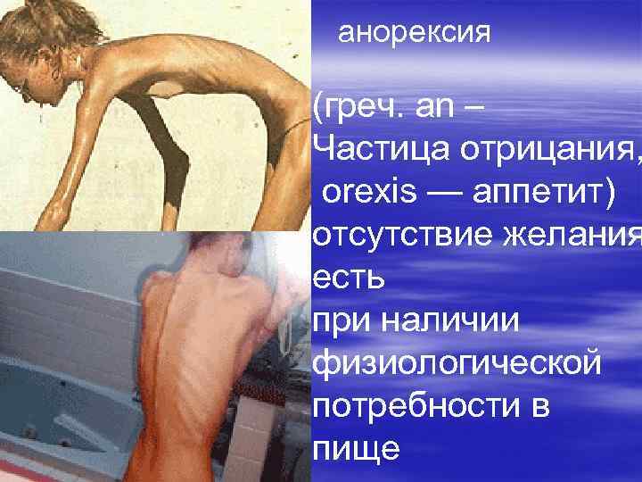  анорексия (греч. an – Частица отрицания,  orexis — аппетит) отсутствие желания есть