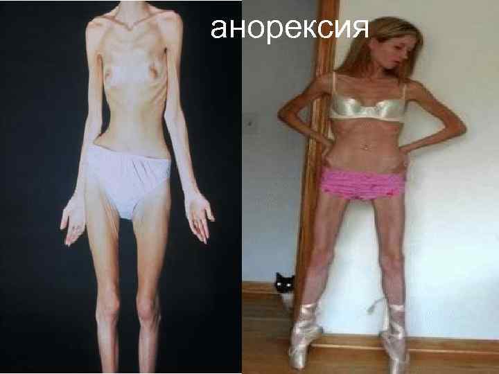 анорексия 
