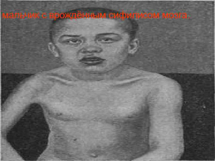 мальчик с врождённым сифилисом мозга. 