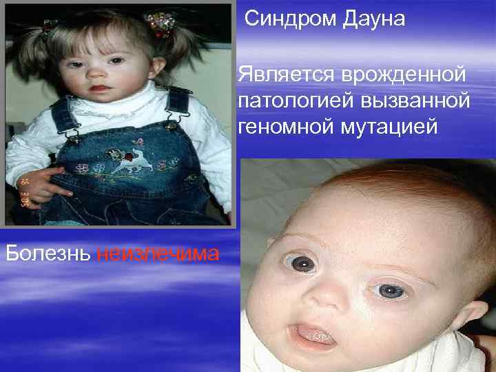      Синдром Дауна    Является врожденной  