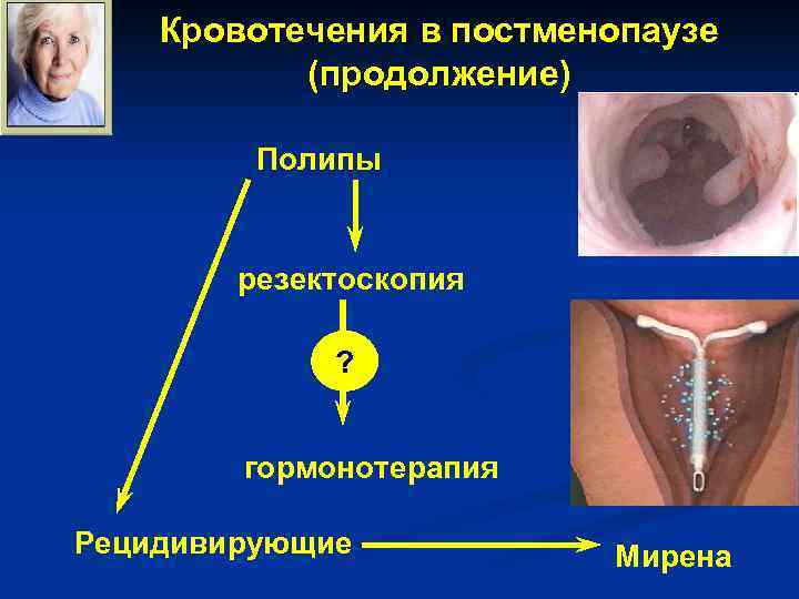 Кровотечения в постменопаузе (продолжение) Полипы резектоскопия Кровотечения в постменопаузе (продолжение) Полипы резектоскопия