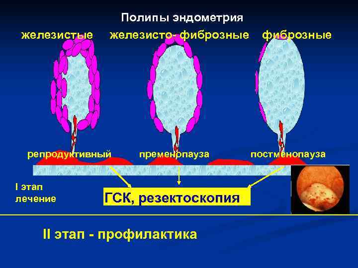 Полипы эндометрия железистые железисто- фиброзные репродуктивный пременопауза Полипы эндометрия железистые железисто- фиброзные репродуктивный пременопауза
