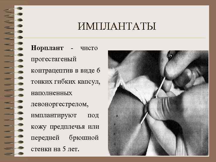     ИМПЛАНТАТЫ Норплант - чисто прогестагеный контрацептив в виде 6 тонких