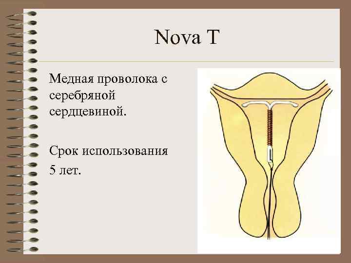     Nova T Медная проволока с серебряной сердцевиной.  Срок использования