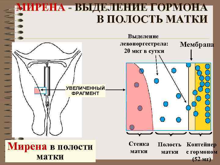 Выделения после мирены