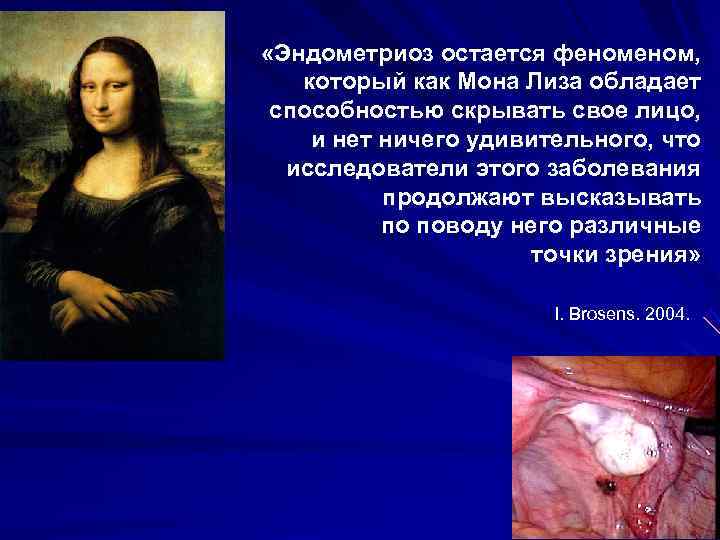  «Эндометриоз остается феном, который как Мона Лиза обладает способностью скрывать свое лицо, и