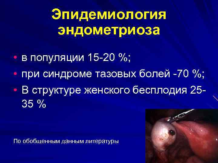   Эпидемиология   эндометриоза • в популяции 15 -20 %;  •