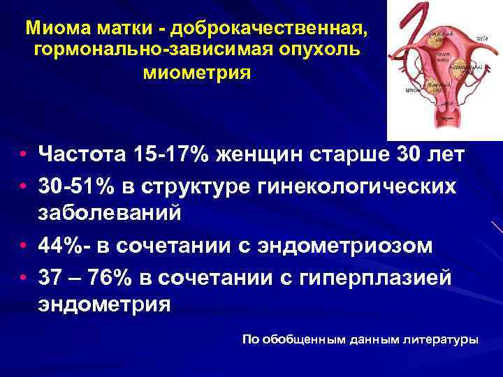 Миома матки - доброкачественная, гормонально-зависимая опухоль  миометрия • Частота 15 -17% женщин старше