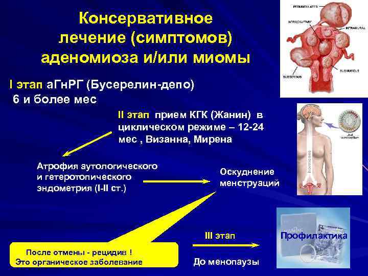    Консервативное  лечение (симптомов) аденомиоза и/или миомы I этап а. Гн.