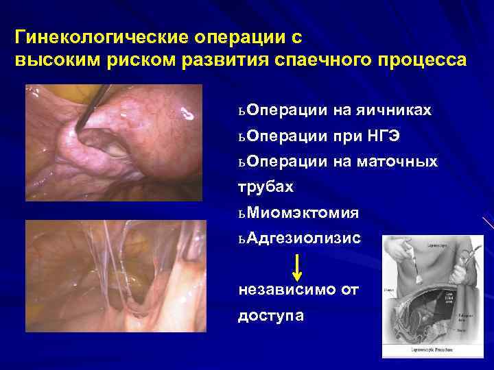 Гинекологические операции с высоким риском развития спаечного процесса     ь Операции