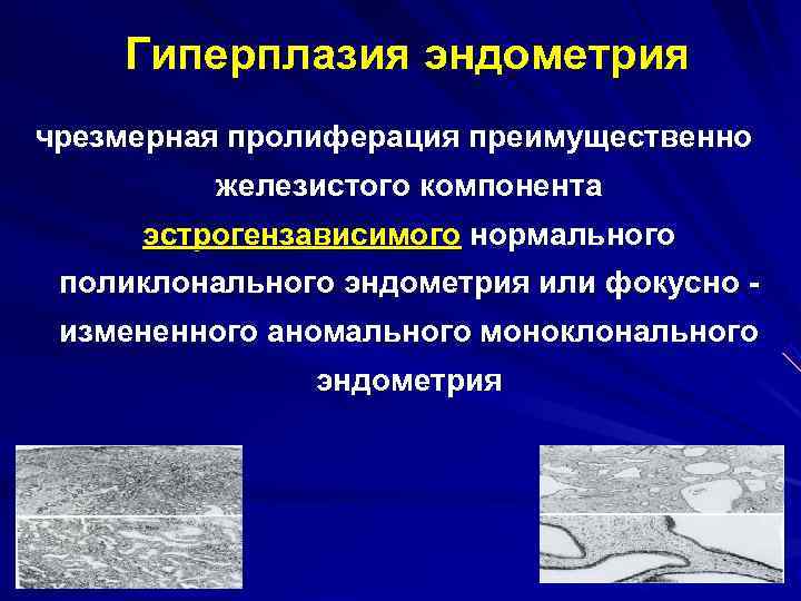   Гиперплазия эндометрия чрезмерная пролиферация преимущественно   железистого компонента эстрогензависимого нормального поликлонального