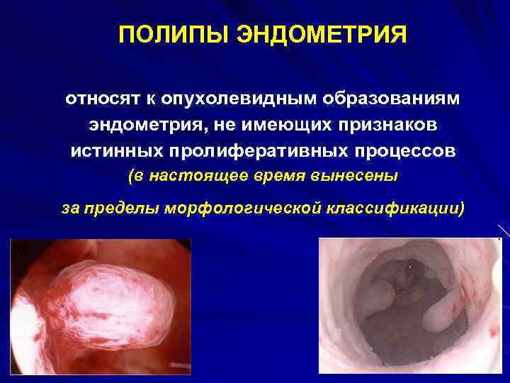  ПОЛИПЫ ЭНДОМЕТРИЯ относят к опухолевидным образованиям  эндометрия, не имеющих признаков истинных пролиферативных