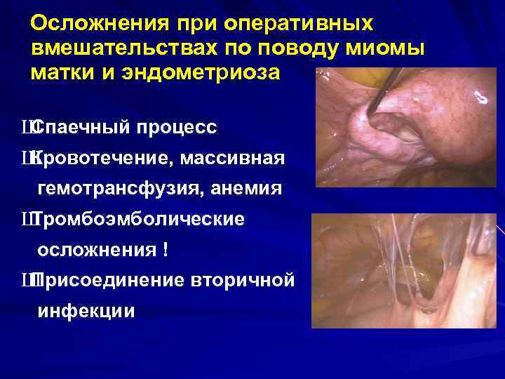 Осложнения при оперативных вмешательствах по поводу миомы матки и эндометриоза Ш Спаечный процесс Ш Осложнения при оперативных вмешательствах по поводу миомы матки и эндометриоза Ш Спаечный процесс Ш