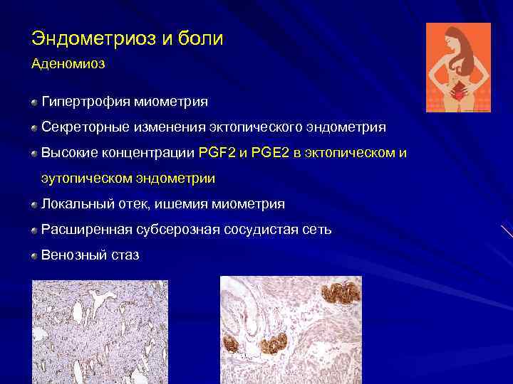 Эндометриоз и боли Аденомиоз Гипертрофия миометрия Секреторные изменения эктопического эндометрия Высокие концентрации PGF Эндометриоз и боли Аденомиоз Гипертрофия миометрия Секреторные изменения эктопического эндометрия Высокие концентрации PGF
