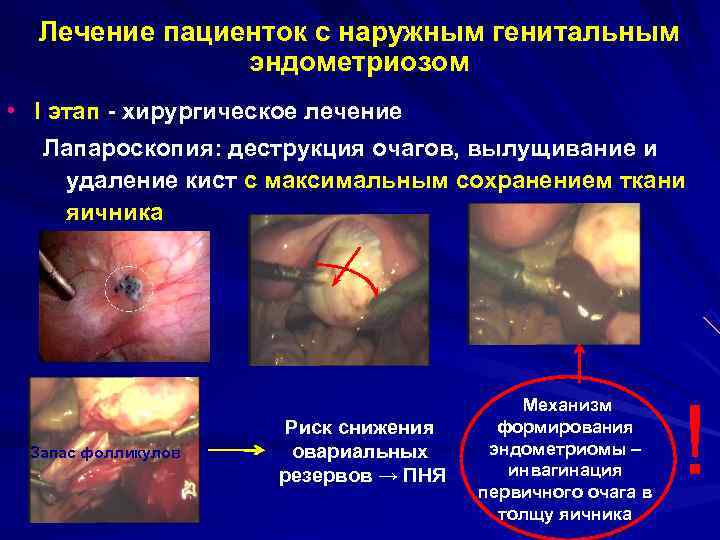 Лечение пациенток с наружным генитальным эндометриозом • I этап - Лечение пациенток с наружным генитальным эндометриозом • I этап -