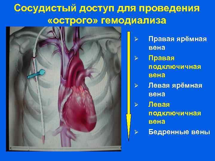 Сосудистый доступ для проведения «острого» гемодиализа Правая ярёмная вена Правая подключичная вена Левая ярёмная