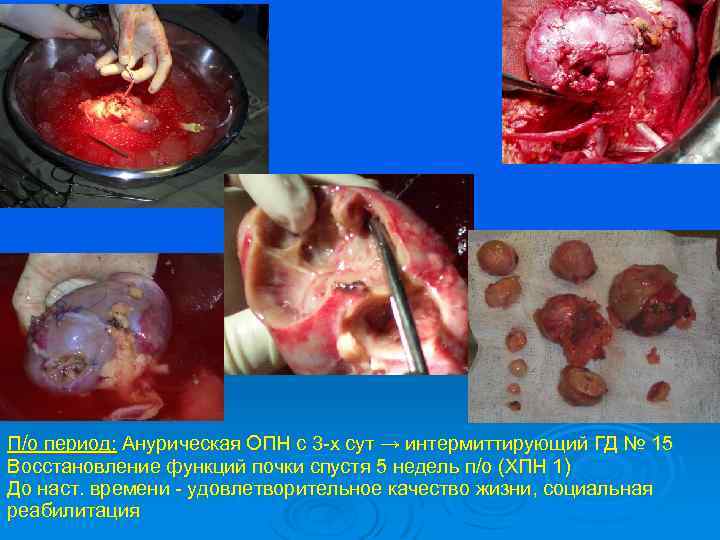 П/о период: Анурическая ОПН с 3 -х сут → интермиттирующий ГД № 15 Восстановление