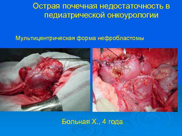 Острая почечная недостаточность в педиатрической онкоурологии Мультицентрическая форма нефробластомы Больная Х. , 4 года
