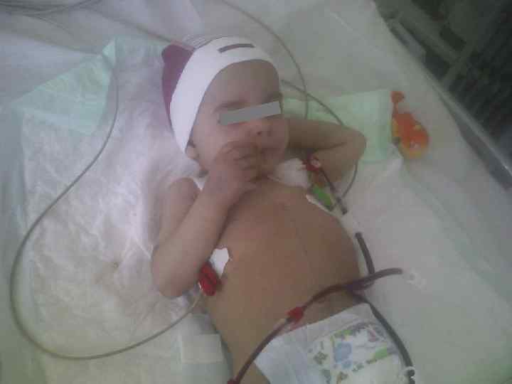 Острая почечная недостаточность в педиатрической онкоурологии Мультицентрическая форма нефробластомы Больная Х. , 4 года