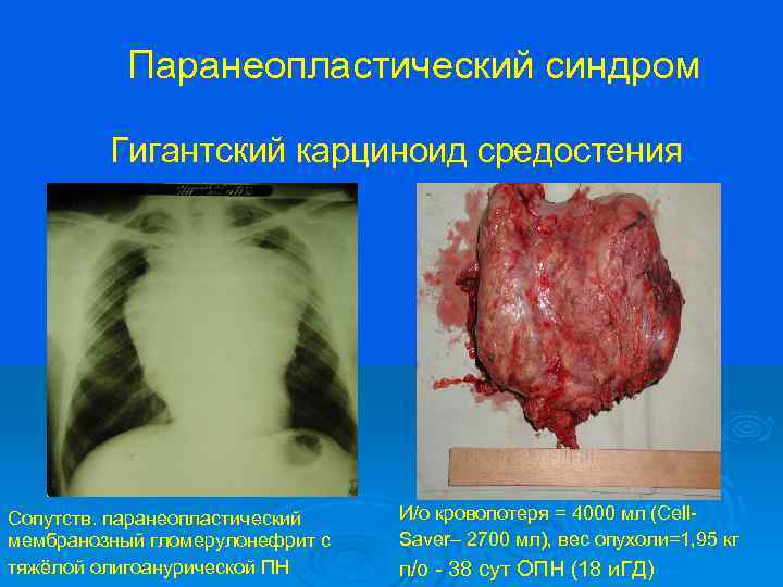 Паранеопластический синдром Гигантский карциноид средостения Сопутств. паранеопластический мембранозный гломерулонефрит с тяжёлой олигоанурической ПН И/о