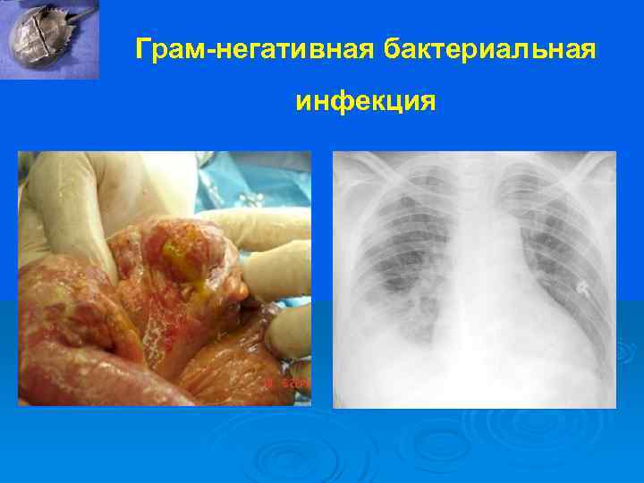 Грам-негативная бактериальная инфекция 