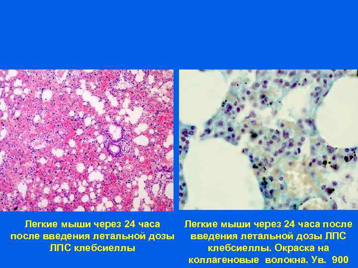 Легкие мыши через 24 часа после введения летальной дозы ЛПС клебсиеллы. Окраска на коллагеновые