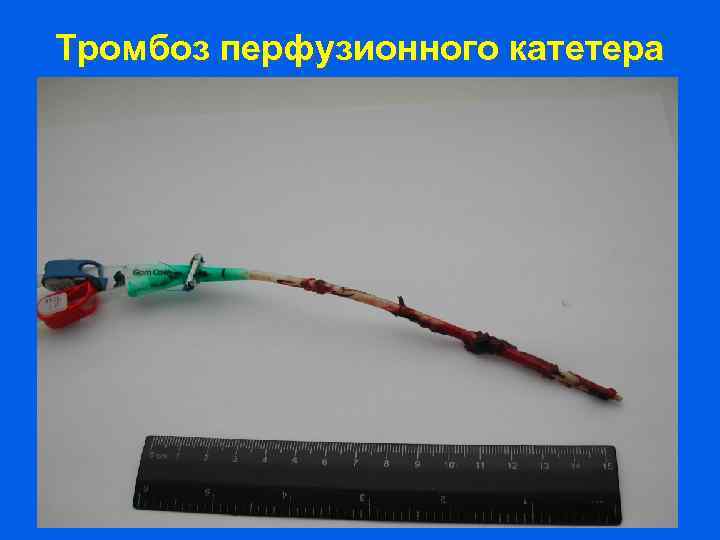 Тромбоз перфузионного катетера 