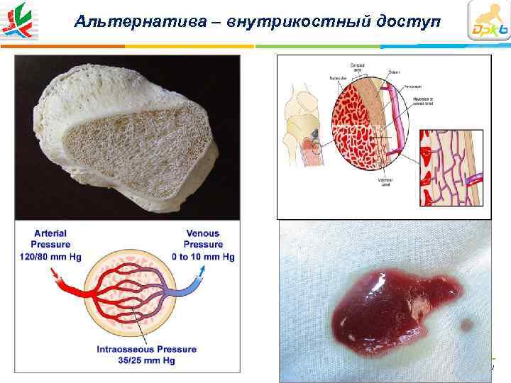 Альтернатива – внутрикостный доступ       ДРКБ МЗ РТ |
