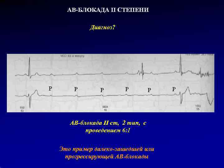  АВ-БЛОКАДА II СТЕПЕНИ    Диагноз? P  P  АВ-блокада II