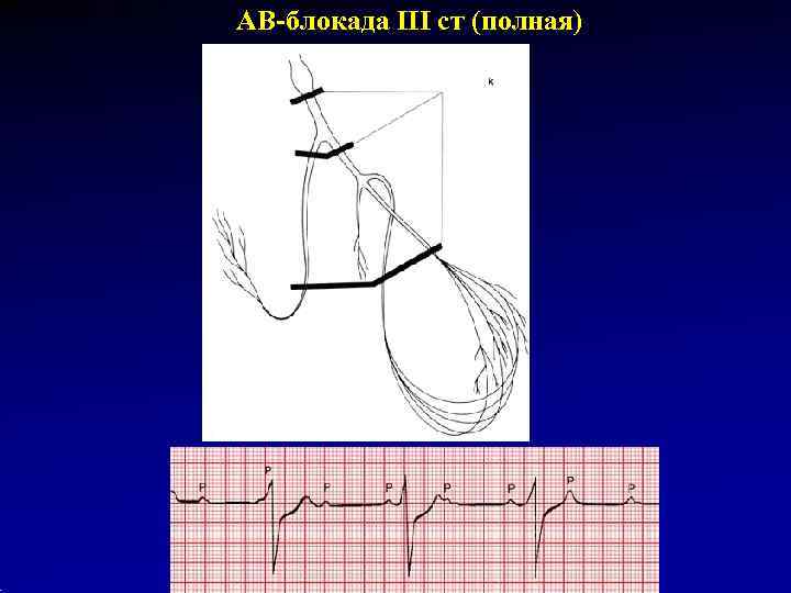 АВ-блокада III ст (полная) 