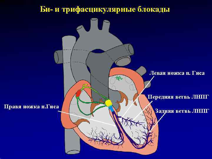   Би- и трифасцикулярные блокады       Левая ножка