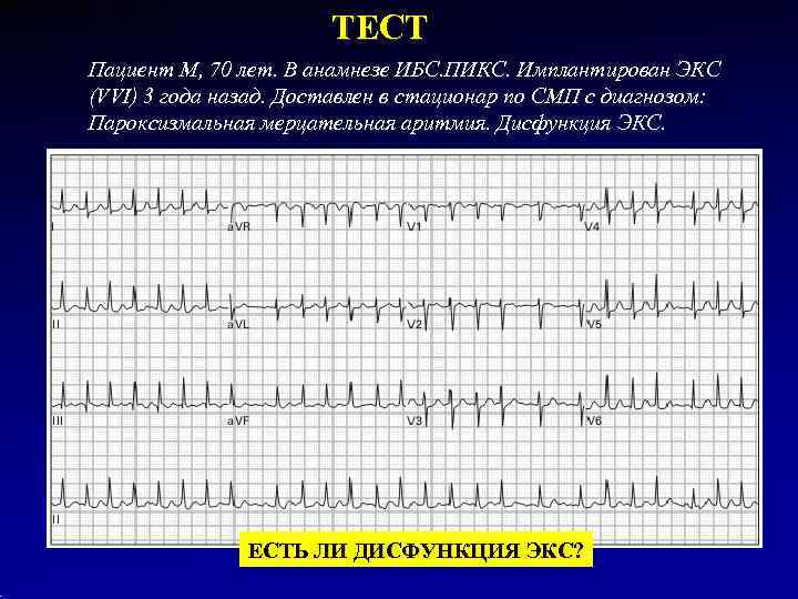     ТЕСТ Пациент М, 70 лет. В анамнезе ИБС. ПИКС. Имплантирован