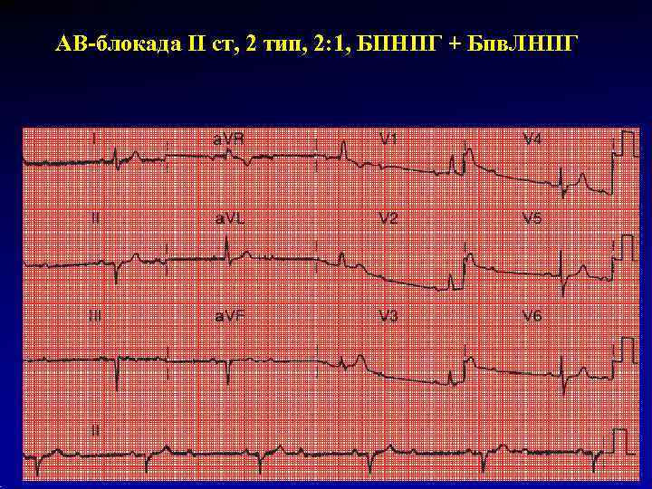 АВ-блокада II ст, 2 тип, 2: 1, БПНПГ + Бпв. ЛНПГ 