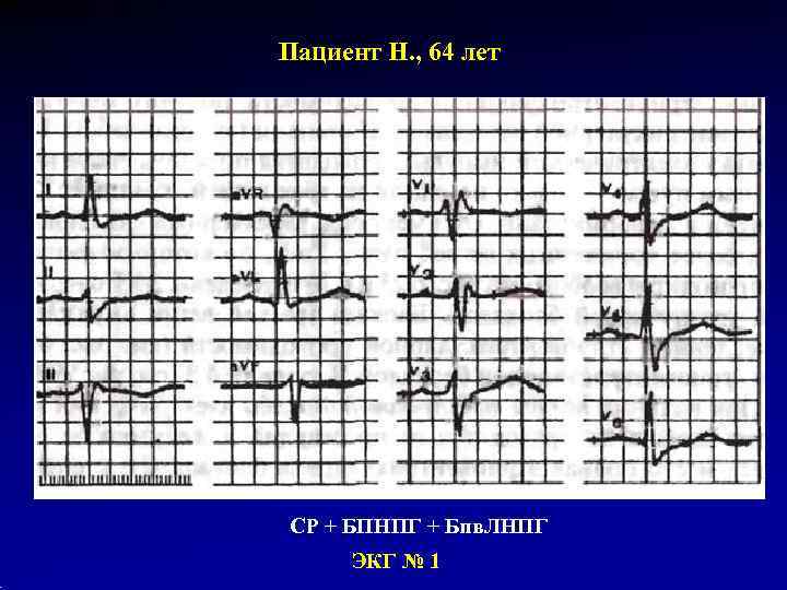 Пациент Н. , 64 лет СР + БПНПГ + Бпв. ЛНПГ ЭКГ № 1