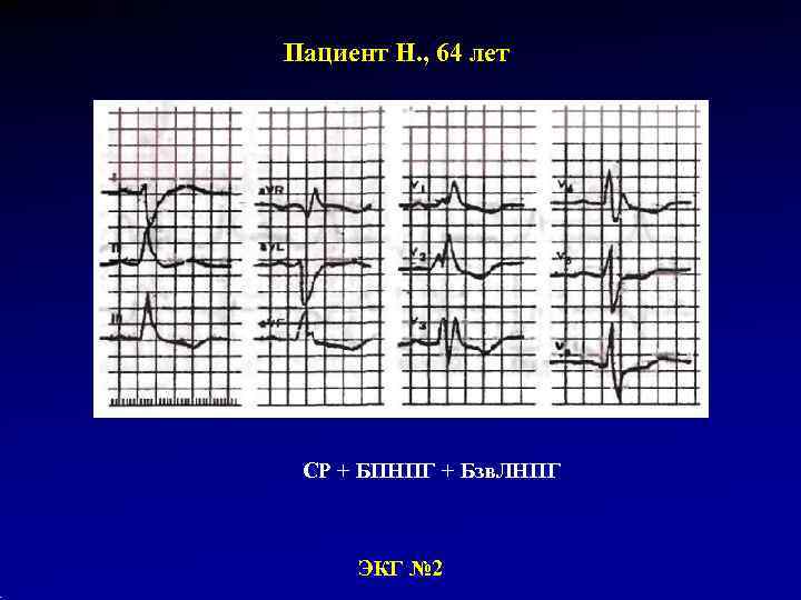 Пациент Н. , 64 лет СР + БПНПГ + Бзв. ЛНПГ   ЭКГ