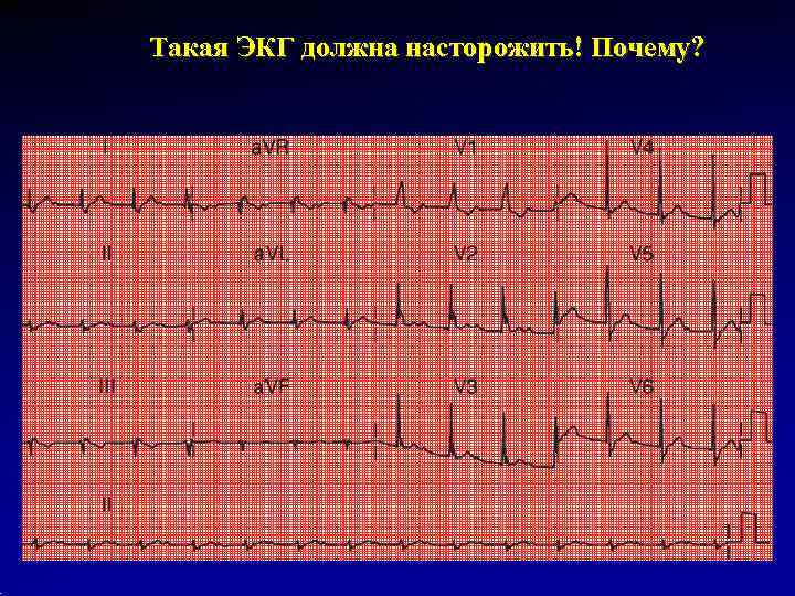 Такая ЭКГ должна насторожить! Почему? 