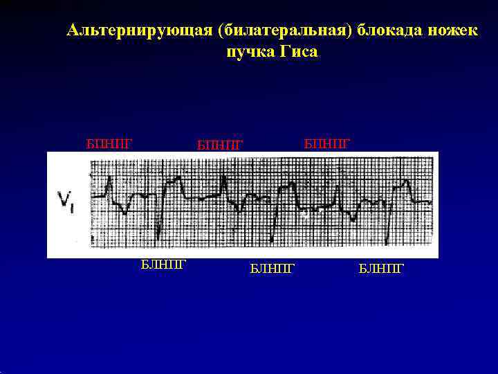 Альтернирующая (билатеральная) блокада ножек   пучка Гиса  БПНПГ    БЛНПГ