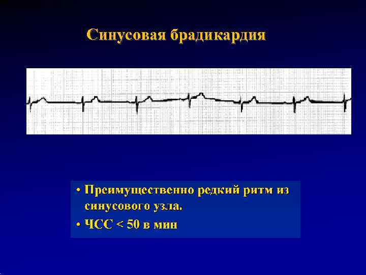 Синусовая брадикардия 
